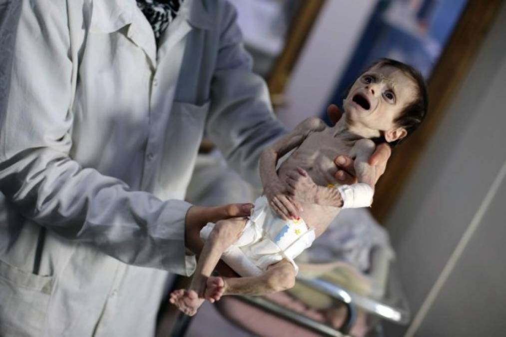 Un bebé desnutrido es trasladado a un hospital en Damasco tras levantarse el asedio a su pueblo.