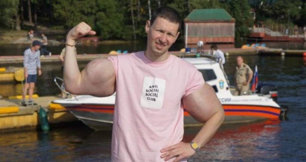 Kirill Tereshin ha decidido pasar por el quirófano para retirar el aceite que en su día se inyectó para aumentar el tamaño de sus bíceps.