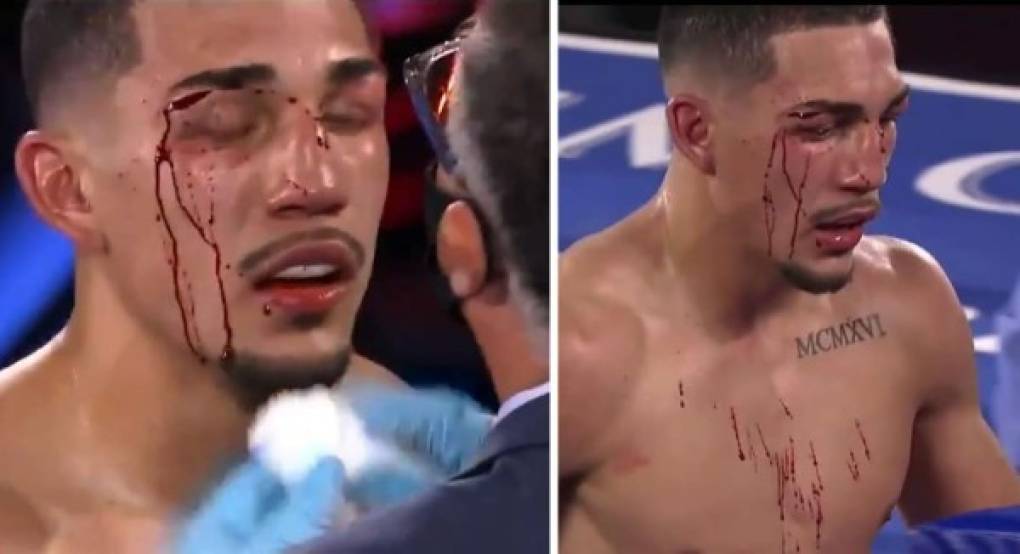 El boxeador hondureño sufrió un corte en su ceja derecha sobre el final de la pelea que le ganó a Vasyl Lomachenko.