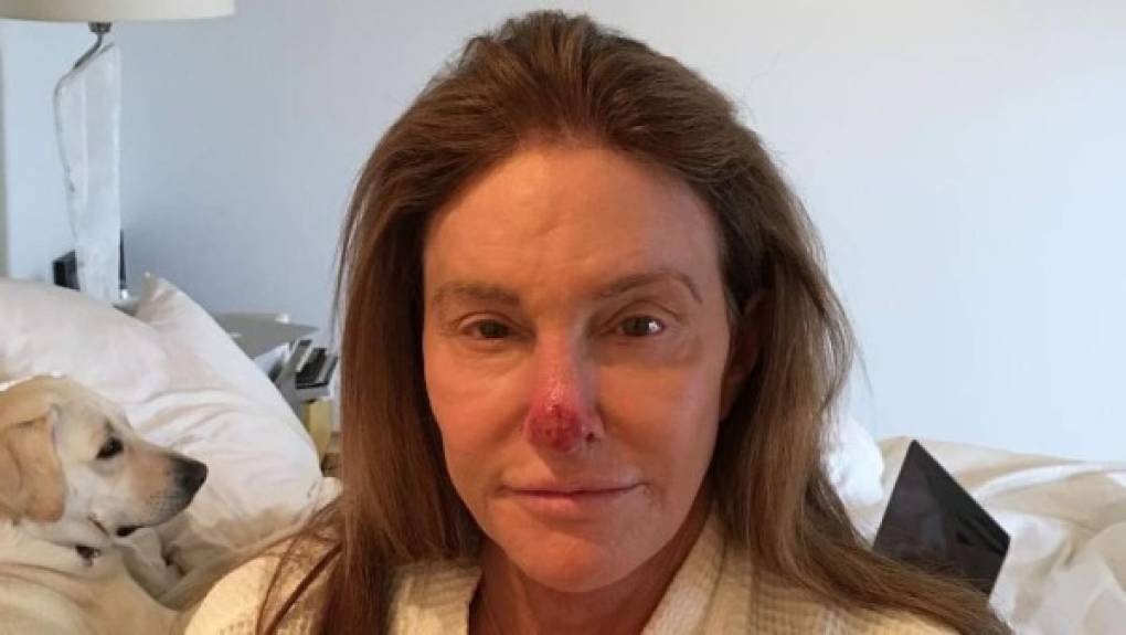 Ahora las Kardashian no hablan con el hombre que ayudó a criarlas.<br/><br/>Caitlyn anunció recientemente que fue operada para remover un cáncer de piel en su nariz.<br/>