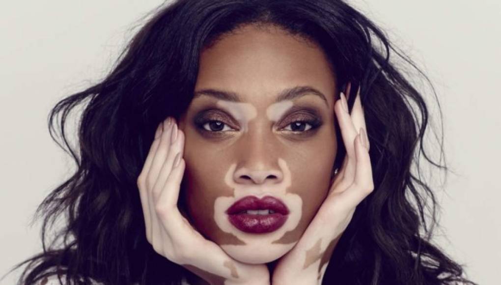 Cuba descubre la cura para el vitiligo