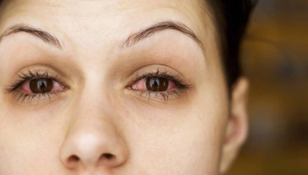 El zika provoca inflamación dentro de los ojos
