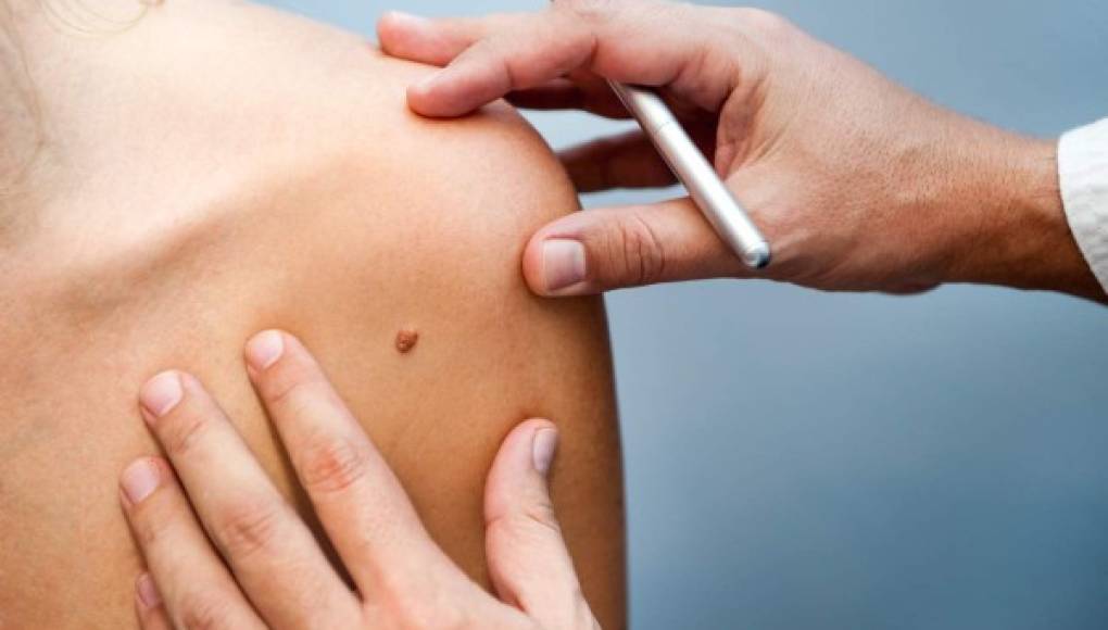 Los autoexámenes ayudan a detectar el regreso del melanoma