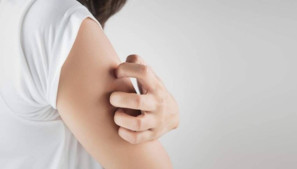 Estrés, exposición al sol e infecciones desencadenan la dermatitis atópica