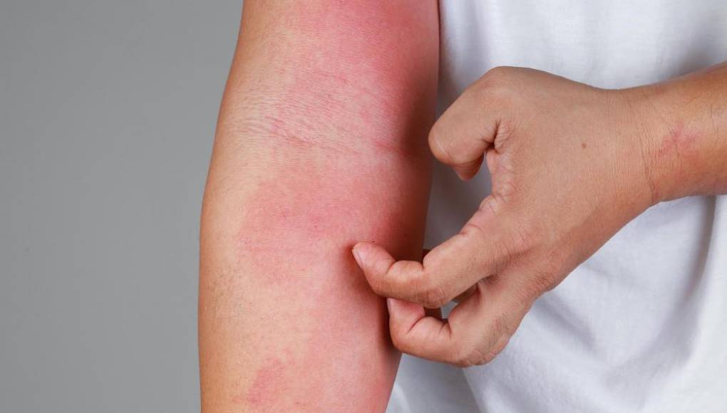 Alergias comunes de la piel en el invierno