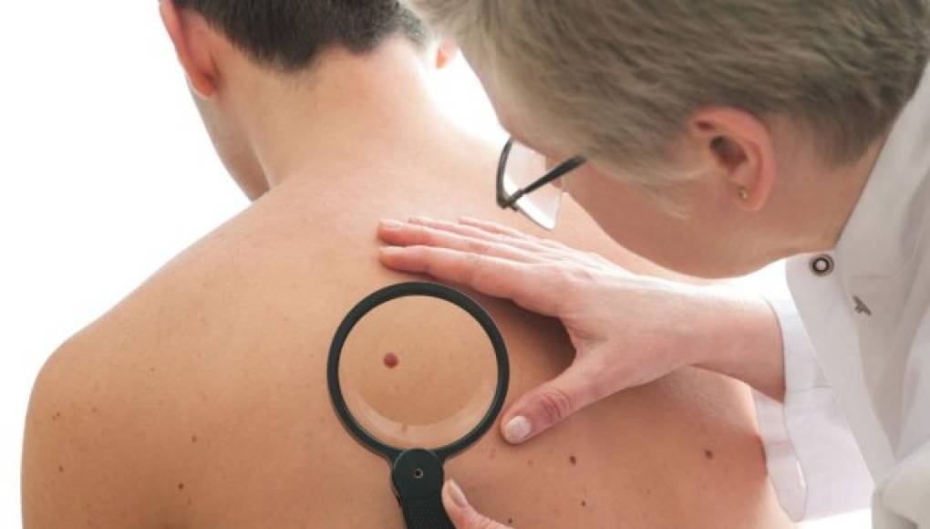 ¿Puede usted reconocer las señales de cáncer de piel?