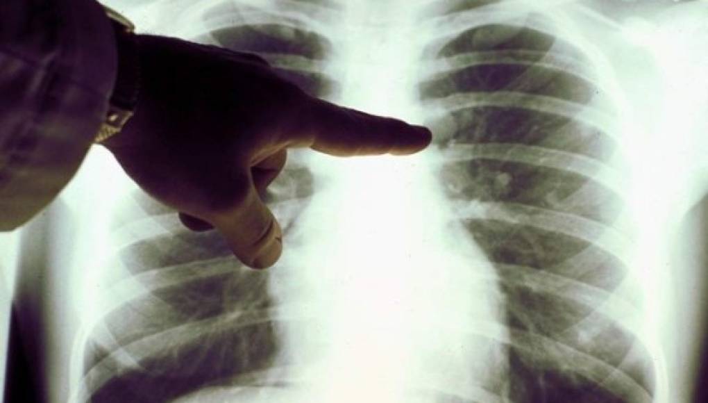 El cáncer de pulmón podría permanecer inactivo durante dos décadas