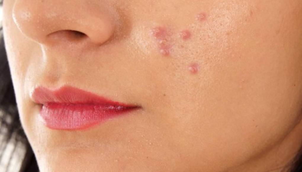 El 'equilibrio' bacteriano en la piel podría ayudar a provocar el acné