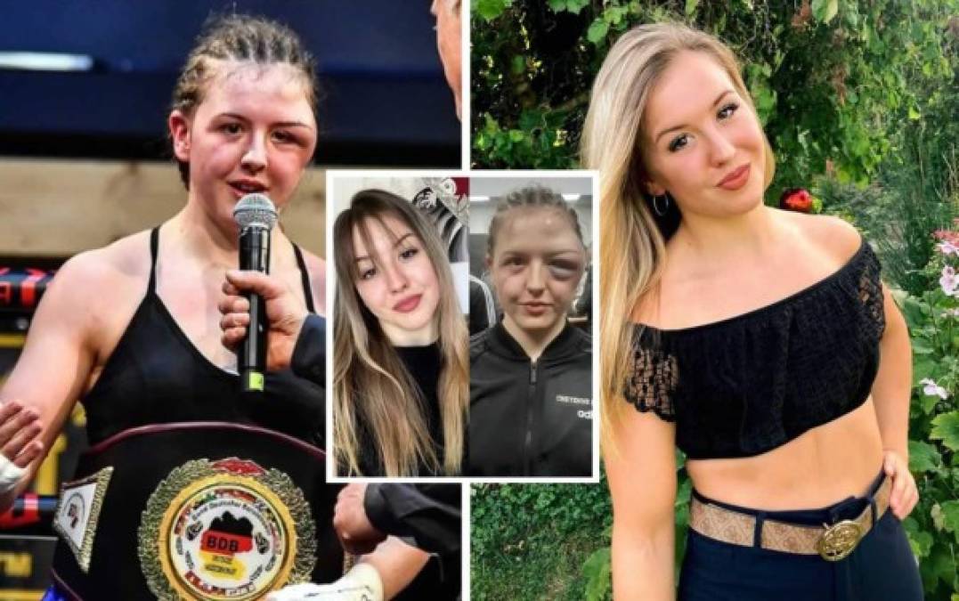 La boxeadora alemana Cheyenne Hanson sufrió una espantosa lesión en una pelea en la que ganó el título de su categoría. La peleadora mostró en redes sociales el antes y después de su rostro deformado.