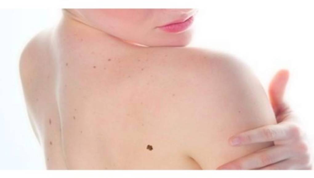 Las personas con pocos lunares tienden a contraer un cáncer de piel más letal