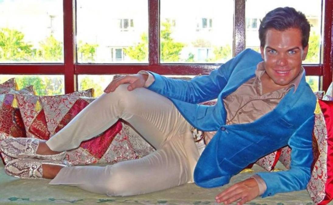 El brasileño Rodrigo Alves, quien tiene más de 24 cirugías estéticas.