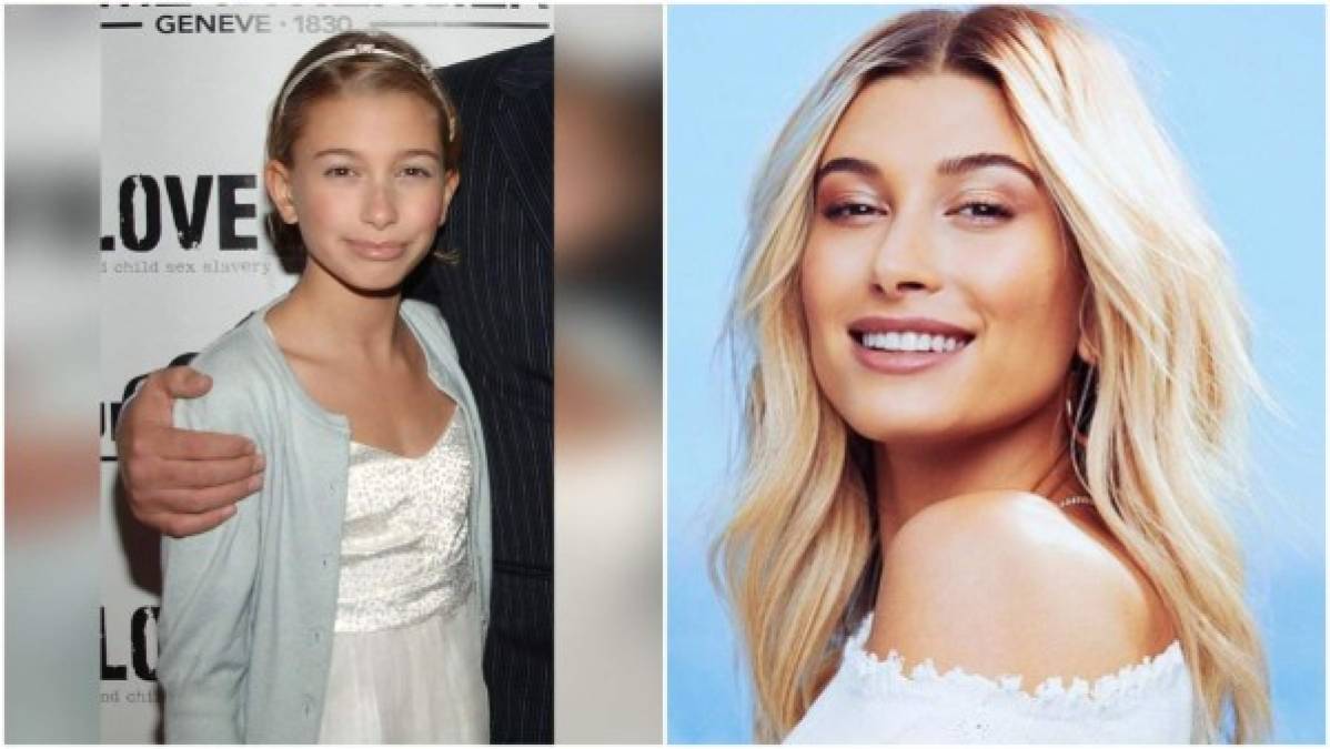 Según los internautas Hailey ha usado 'fillers', rellenos dérmicos que ayudar a tener labios voluptuosos y también se usan para definir el contorno del rostro, entre otras cosas. Además de otros retoques estéticos.