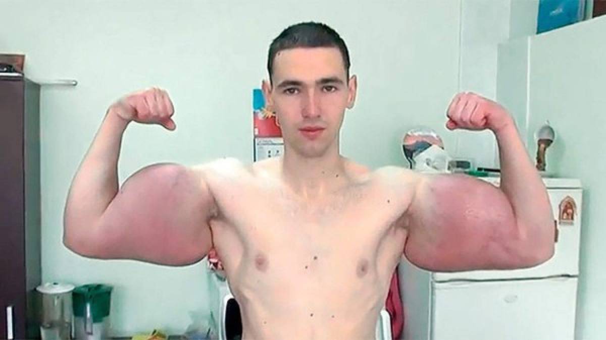 El ruso se introdujo en los brazos anteriormente una sustancia llamada Synthol que se compone en un 85% de aceite, un 7,5% de lidocaína y el 7,5% restante de alcohol.