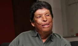 Irwin Sánchez, el hombre de las 80 cirugías y los 120 injertos