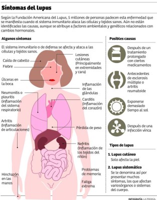 Nueve casos de lupus son detectados al mes en San Pedro Sula