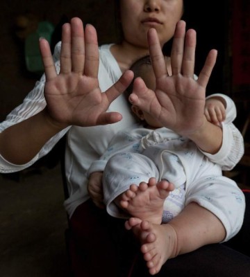 Hong Hong, el bebé chino que tiene 31 dedos