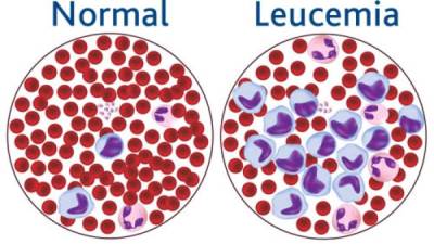 La leucemia es una enfermedad que afecta la sangre del pacientes.