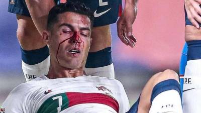 Cristiano Ronaldo no la pasó nada bien este sábado en Praga pese a que Portugal goleó 4-0 a República Checa por la UEFA Nations League. El crack luso se llevó un terrible golpe que le dejó ensangrentado su rostro.