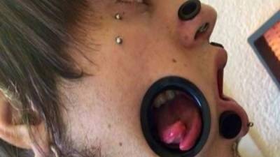 Mediante una operación, este joven alemán se abrió una 'segunda boca' en la mejilla derecha para comer a través de ella.