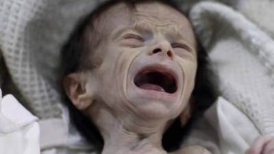 Las imágenes de Saha Dofdaa, una niña con un severo caso de desnutrición, expone los horrores que afectan a Siria, envuelto en una guerra civil desde el 2011 que ha costado más de 300,000 vidas, según estimaciones de organismos de Derechos Humanos.ADVERTENCIA: imágenes sensibles, se recomienda discreción.