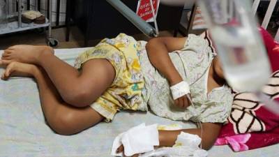 Foto de un menor que sufrió quemaduras y se recupera en el Hospital Escuela.