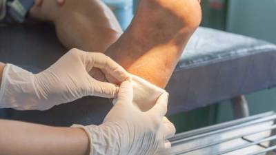 El problema del pie diabético se debe a los cambios que sufren los vasos sanguíneos y los nervios, que pueden conducir a la ulceración y amputación del miembro.