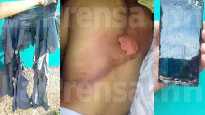 Ángel Rigoberto Mejía sufrió quemaduras en su espalda tras ser alzanzado por un rayo.