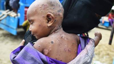Bangladés. Las víctimas inocentesUna madre atiende a su hijo enfermo en uno de los campamentos para refugiados rohinyás en Bangladés.