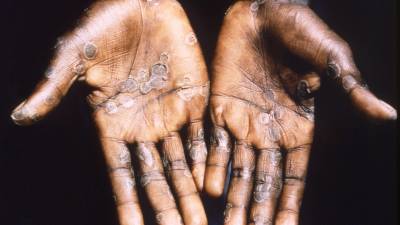 Imagen de las lesiones en la piel provocadas por la viruela del mono, durante un estudio llevado a cabo en la República Democrática del Congo entre los años 1996 y 1997. EFE/ Brian W.j. Mahy/Center for Disease Control and Prevention