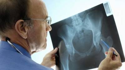 Se están perdiendo oportunidades de identificar a las personas con un ACV que tienen un mayor riesgo de fracturas, y de iniciar el tratamiento para prevenir la pérdida y las fracturas óseas.