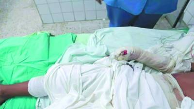 Uno de los pacientes adultos a quien se le amputaron dos dedos luego de la explosión de un mortero.