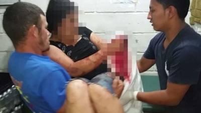 La mujer perdió una de sus manos en el ataque.