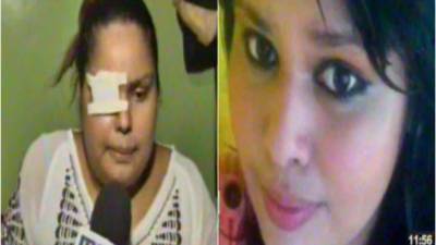 Lilian Hernández fue víctima de su pareja que le lanzó una piedra y le impactó su ojo derecho.