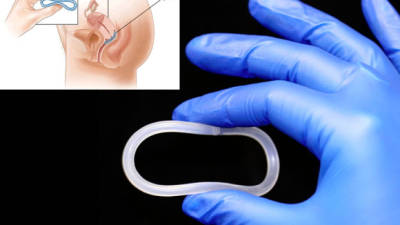 El anillo vaginal utilizado para la prevención de embarazos ahora ayuda a prevenir el VIH y el virus del herpes genital.