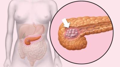 Una proteína involucrada en el desarrollo del cáncer de páncreas.