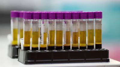 Imagen de archivo de muestras de sangre para tests del VIH y Sida. EFE