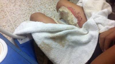 Quemaduras de segundo grado en las piernas recibió un niño de nueve años después de que le cayera un volcán la noche del 24 de diciembre.