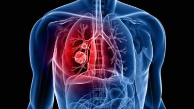 La diana fue probado en tratamiento de cáncer de pulmon.