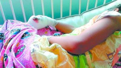 Esta niña de 10 años llegó desde Intibucá con quemaduras por pólvora. Está interna en el Hospital Escuela.