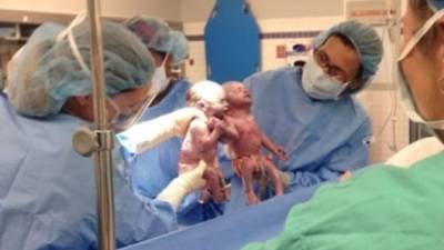 Los médicos que atendieron el parto se sorprendieron al ver a las pequeñas tomadas de la mano. Los investigadores dicen que sólo uno de cada 10,000 nacimientos es de gemelos que comparten la placenta.
