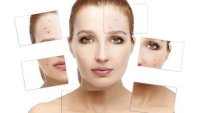 Los cuidados básicos de limpieza de la piel pueden ayudarle a evitar el aparecimiento del acné