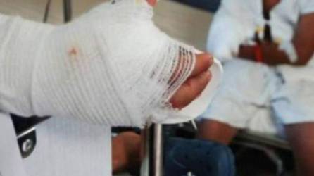 Uno de los menores ingresados la noche del miércoles 27 de diciembre fue afectado por un mortero que le causó daños en su mano derecha.