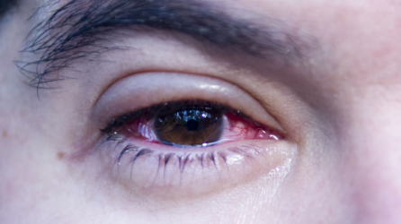 La conjuntivitis es una irritación o inflamación de la conjuntiva que cubre la parte blanca del globo ocular.
