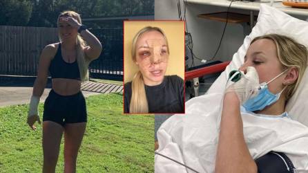Joven sufre terribles heridas en el rostro tras fuerte accidente en motocross
