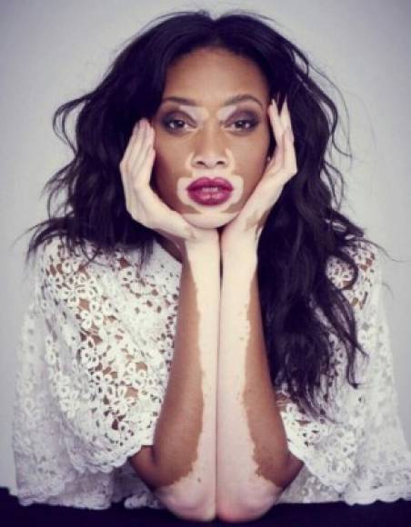 Chantelle Young es una joven canadiense que padece de vitiligo:Enfermedad cutánea que se caracteriza por la aparición de manchas blanquecinas debidas a una deficiencia de pigmentación (RAE).Foto:www.reddit.com