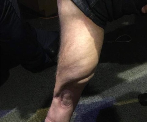 Futbolista muestra como le quedó la pierna tras terrible lesión