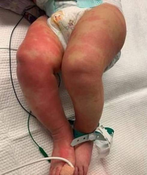 Una bebé de apenas seis meses de edad fue la última paciente diagnosticada con la enfermedad de Kawasaki y el coronavirus en San Francisco, California. Los médicos creen que es el primer caso registrado de un niño estadounidense que presenta ambas enfermedades al mismo tiempo.