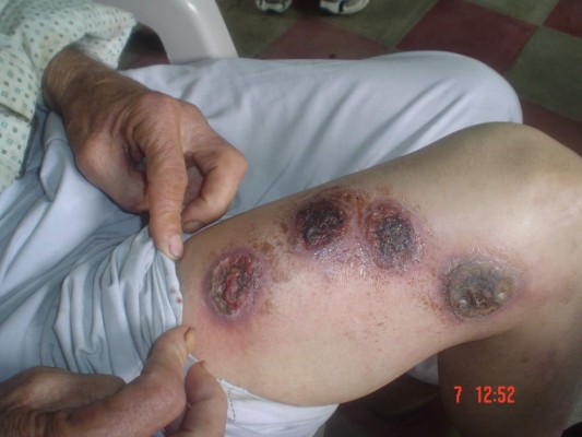 Falta de aseo y moscas provocan leishmaniasis en la piel de sampedranos