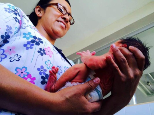 Suman 28 los nacimientos de niños con microcefalia en Honduras  
