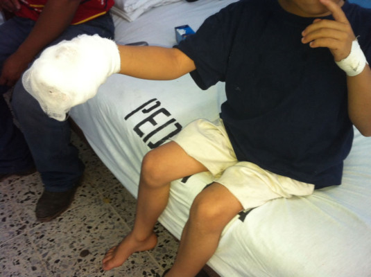 Honduras: Un niño se quema una mano con pólvora en Santa Bárbara